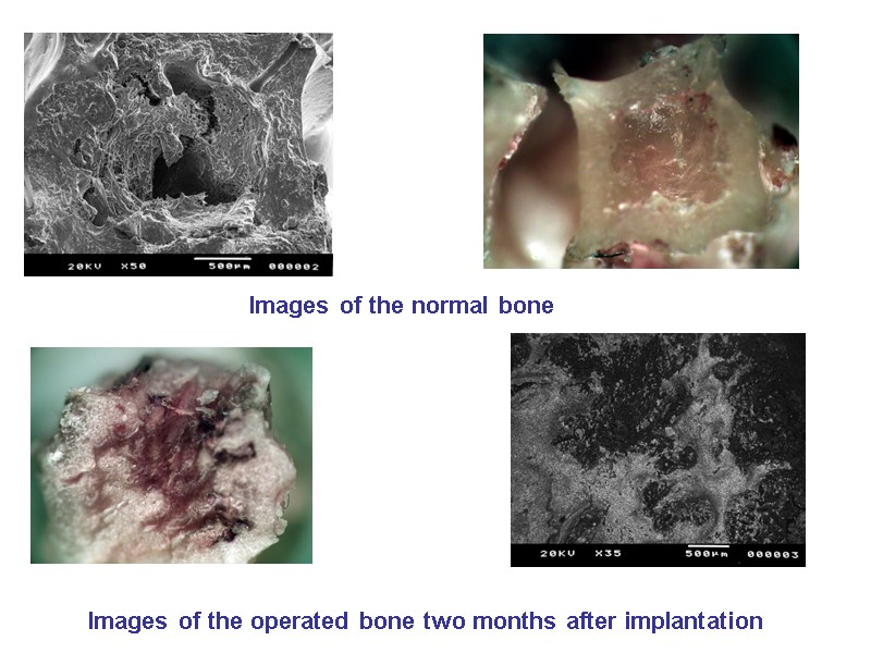 Images of the operated bone two months after implantation Images of the normal bone